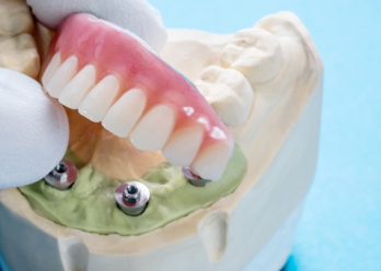 A guide to implant-supported dentures