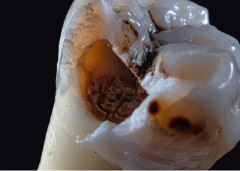 What does it mean to have a tooth cavity?