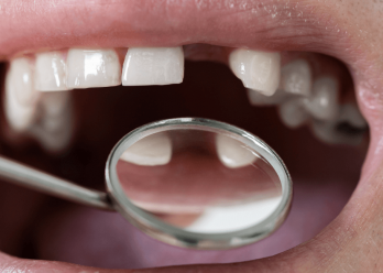 Tooth replacement options to fix missing teeth