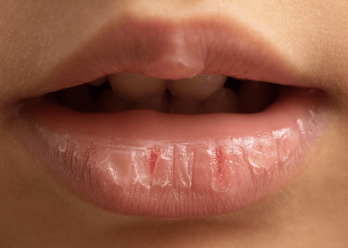 Causes of a dry mouth and the importance of saliva