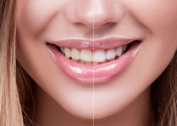 Teeth whitening at home vs. professional teeth whitening at arana hills